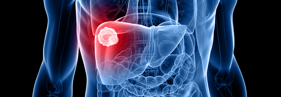 In der Studie LEAP werden zurzeit verschiedene Kombinationsmöglichkeiten als neue systemische Therapien für das fortgeschrittene Leberzellkarzinom verglichen.