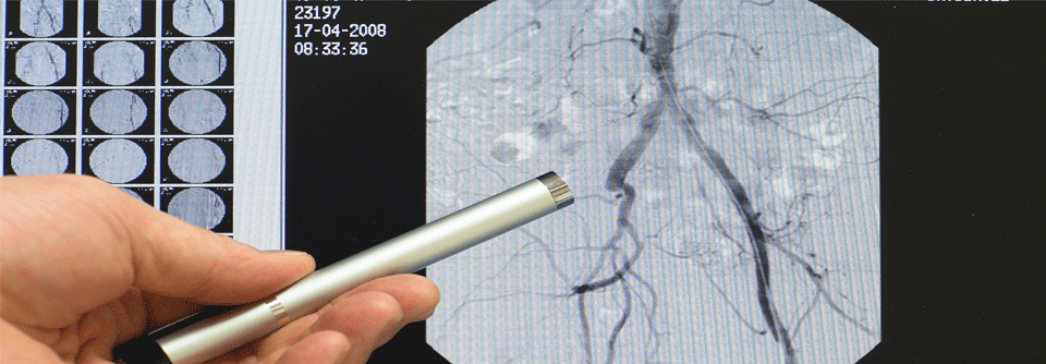 Aus ökonomischer Sicht schnitt die endovaskuläre Therapie günstiger ab.