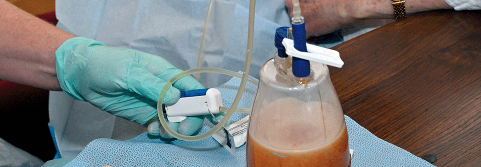 Pleuraerguss: Wann auf eine Punktion verzichtet werden kann Bei Patienten mit malignem Pleuraerguss kann die Anlage einer Thoraxdrainage notwendig werden.