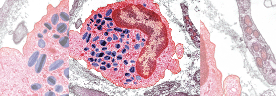 Bei der Phänotypisierung des Asthmas spielen die Eosinophilen eine wichtige Rolle.