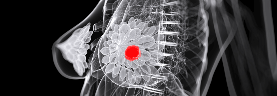 In der deutschen Registerplattform OPAL wurden verschiedene Strategien bei Patient:innen mit HR+/HER2- Brustkrebs mit früher Progression untersucht.
