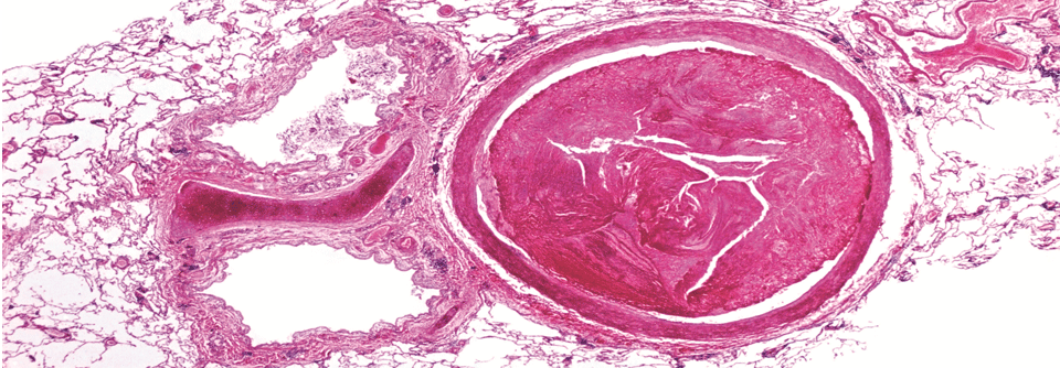 Ein Thrombus hat die Lungenarterie weitgehend verschlossen.