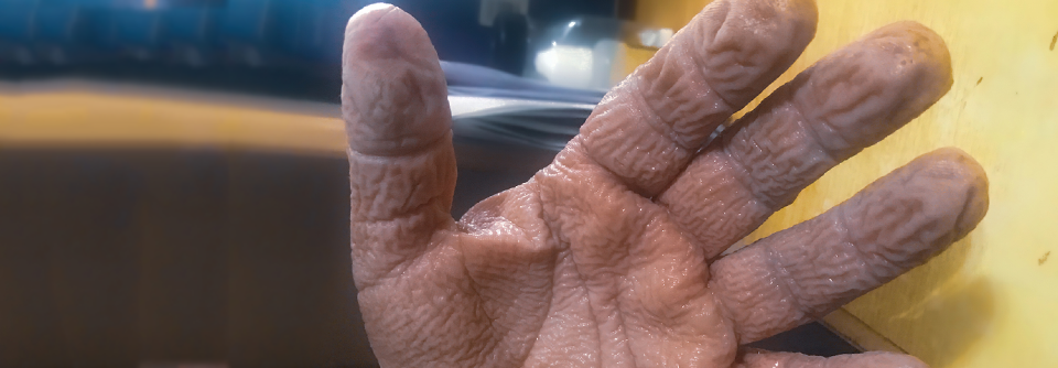 Die aquagene Faltenbildung der Handinnenfläche kann auch im Zusammenhang mit ungewöhnlichen CFTR-Mutationen mit milderem klinischen Verlauf der zystischen Fibrose auftreten.