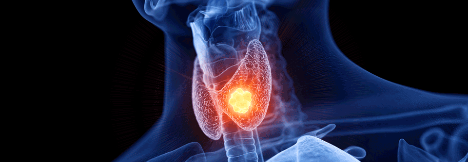 Für die Erstlinie im fortgeschrittenen Stadium der medullären Schilddrüsenkarzinome steht ab sofort ein spezifischer RET-Inhibitor zur Verfügung. 