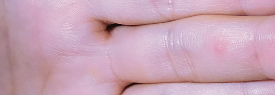 Einzelne Affenpocken-Läsionen wie hier am Mittelfinger können sich primär als unspezifische Papeln manifestieren.
