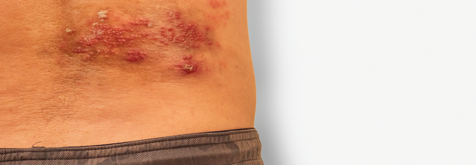Typisches Bild mit rotem Ausschlag und flüssigkeitsgefüllten Bläschen im Bereich eines Dermatoms.
