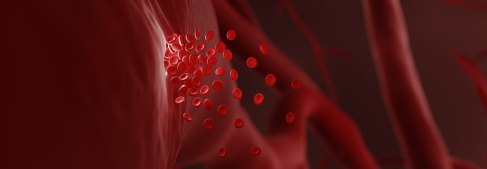 Die Ansprechrate auf rFVIIa bei Blutungsereignissen im Rahmen einer angeborenen Hämophilie A oder B beträgt um die 90 %.