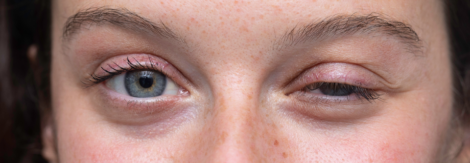 Diese Myastheniepatientin versucht vergeblich, ihr rechtes Auge zu öffnen.