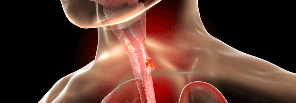 Ein Referent beim DKK zeigt anhand  eines Patientenfalls, warum eine Operation bei der derzeitigen Diagnostik des Ösophaguskarzinom sehr zu empfehlen ist.