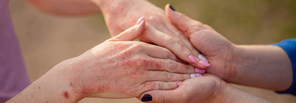 Patienten mit Atopischer Dermatitis weisen eine Dysbiose des Hautmikrobioms auf.