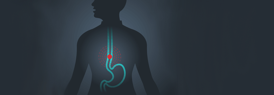 Für die Zulassung der Checkpoint-Inhibitoren Nivolumab und Ipilimumab  bei verschiedenen Tumorentitäten, spielt der PD-L1-Biomarkerstatus eine wichtige Rolle.