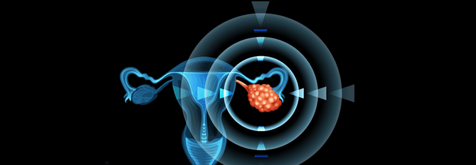 Ob das Risiko für MDS/AML durch die Erhaltungstherapie mit einem PARP-Inhibitor bei fortgeschrittenem Ovarialkarzinom erhöht wird, soll geklärt werden.