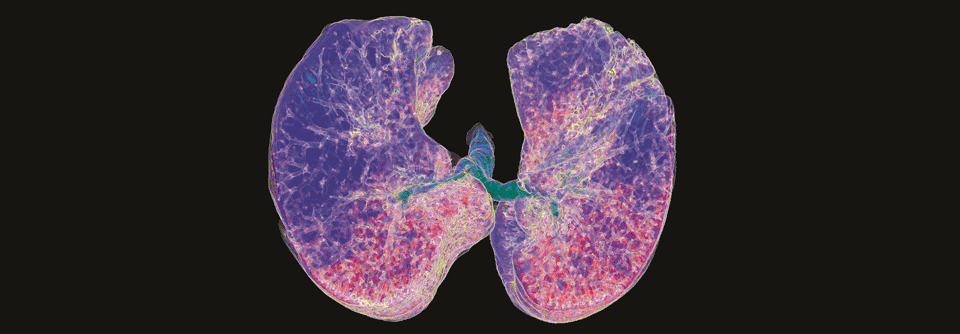 3D-CT-Scan eines Patienten mit interstitieller Lungenerkrankung sowie interstitieller Fibrose infolge einer COPD.
