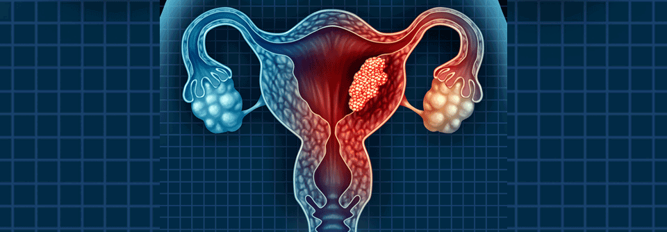 Die S3-Leitlinie Endometriumkarzinom wurde unter Federführung der Deutschen Gesellschaft für Gynäkologie und Geburtshilfe e. V. und der Arbeitsgemeinschaft Gynäkologische Onkologie aktualisiert.