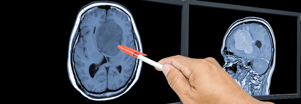 Die Behandlung von Hirnfiliae sollte in einem multidisziplinären Team erfolgen, um optimale Sequenzen aus lokalen und systemischen Therapien festzulegen.