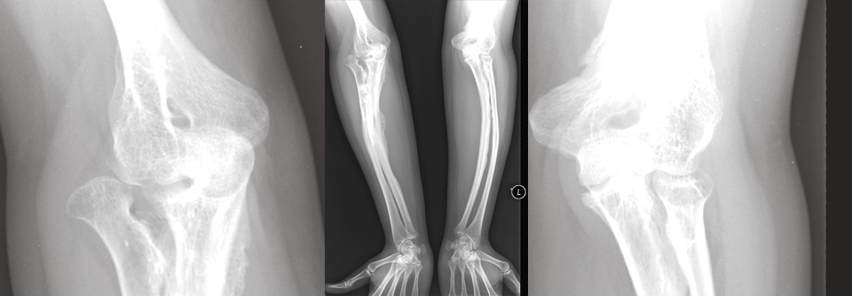 Bei ausgeprägten Deformitäten schon bei der Geburt ist bei Sistieren der motorischen Entwicklung sowie bei Schmerzen und Frakturen die Begradigung der Extremitäten per Osteotomie indiziert.