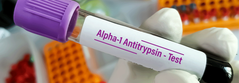 Substitutionstherapie bei Patienten mit Alpha-1-Antitrypsin-Mangel unabhängig von Genotyp und FEV<sub>1</sub> AATM ist eine erbliche Erkrankung, der eine Mutation des SERPINA1-Gens zugrunde liegt.