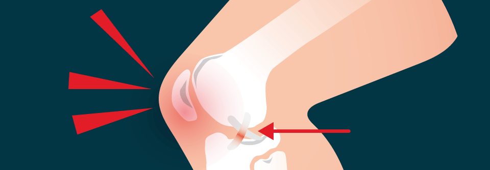 Kreuzbandrisse entstehen vor allem bei Sportverletzungen. Am häufigsten ist das Lig. cruciatum anterius betroffen.