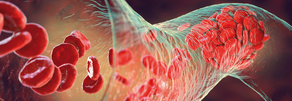 Bei Patient:innen mit einer SARS-CoV-2-Infektion sollte man sorgfältig auf Zeichen arterieller oder venöser Thrombosen achten.