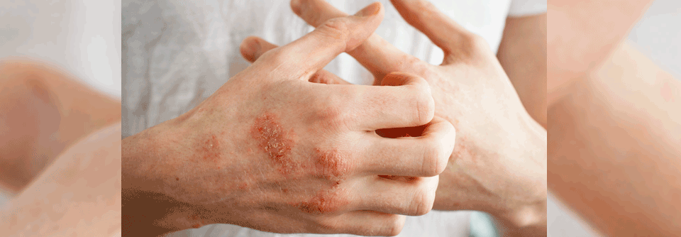 Die Therapie mit Checkpoint-Inhibitoren zeigt sich oft durch immunvermittelte Nebenwirkungen an der Haut.
