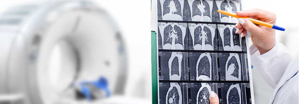 Dank low-dose CT-Screening kann 
Lungenkrebs schon in einem frühen Stadium erkannt werden, sodass sich die Überlebensprognose von Patient:innen enorm verbessert.