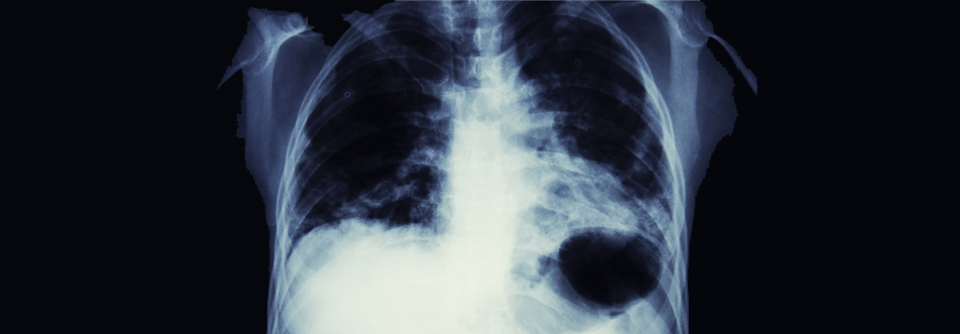 Immuntherapeutika verlängern das Überleben beim NSCLC.