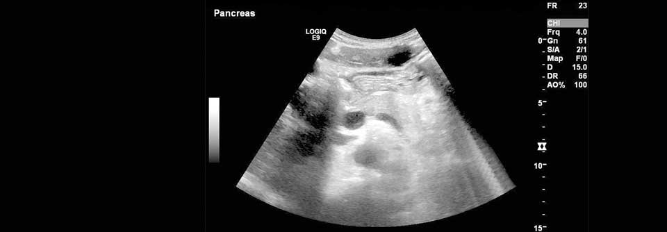 Die Pankreaszysten bei diesem Patienten sind im Ultraschall gut zu erkennen.