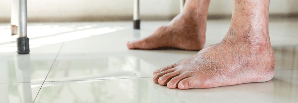 Auch wenn man ein diabetisches Fußsyndrom zur Abheilung gebracht hat, darf man sich nicht zurücklehnen – das Risiko für Rezidive ist hoch und die Betroffenen bleiben dauerhaft gefährdet. 