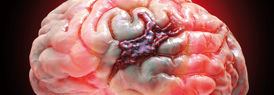 Im ersten Schritt gingen die Wissenschaftler dem Zusammenhang zwischen chronischer Nierenerkrankung (chronic kidney dis­ease, CKD) und intrazerebraler Hämorrhagie anhand von Daten aus der  ERICH*-Studie nach.