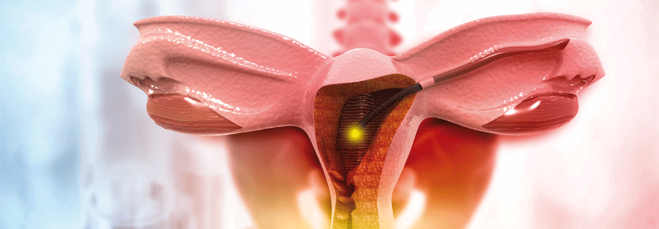 Im Rahmen einer Studie unterzog sich eine Hälfte vor der spontanen Menopause einer bilateralen Ovarektomie aus benigner Indikation, die andere Hälfte ließ sich die Eierstöcke nicht entfernen.