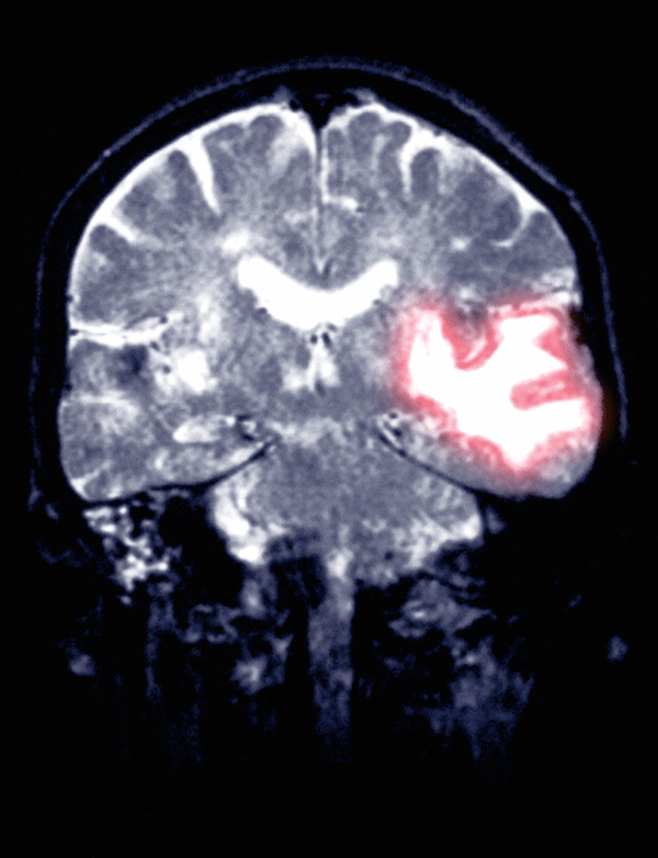 Das kraniale MRT einer 77-Jährigen zeigt eine Hirnblutung temporoparietal.