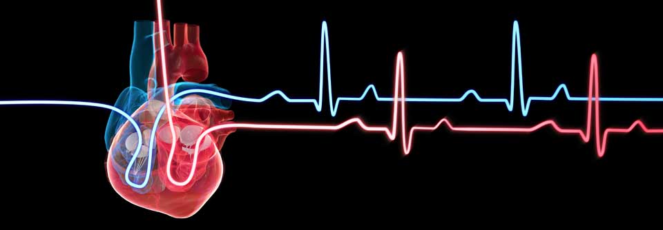 Eine gepoolte Analyse konnte zeigen, dass der SGLT2-Inhibitor Morbidität und Mortalität bei chronischer Herzinsuffizienz reduziert.