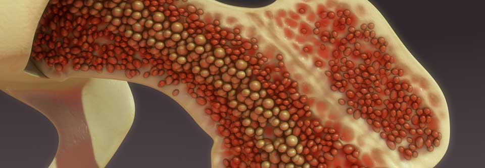 Bestimmte Blutzellen werden bei myeloproliferativen Neoplasien im Übermaß gebildet.