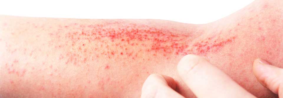 Von einer Behandlung der atopischen Dermatitis profitierten sowohl Patient:innen mit mittelschwerer Erkrankung, als auch Patient:innen mit schwerer Erkrankung.