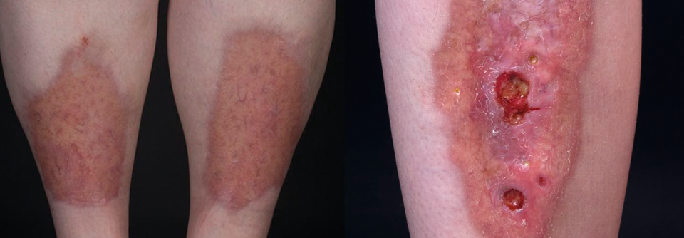 Necrobiosis lipoidica: neue Therapieansätze zusammengefasst Links: Typisches Bild einer Necrobiosis lipoidica an den Streckseiten der Unterschenkel. Rechts: Ulzerationen bilden sich meist nach
frühestens zwölf Monaten und vornehmlich bei Männern.