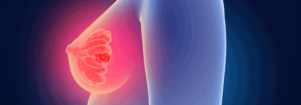 Für die adjuvante Therapie des frühen HR+/HER2- Mammakarzinoms wurde kürzlich ein CDK4/6-Inhibitor in Kombination mit einer endokrinen Behandlung zugelassen.