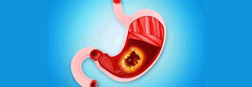 Patient:innen mit Adenokarzinomen im Magen und gastroösophagealem Übergang erweitern sich durch eine neue Studie die Therapieoptionen.