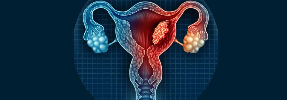 Für Patientinnen mit Endometrioskarzinom ergaben sich in einer Studie signifikante Verbesserungen in Bezug auf OS und PFS.