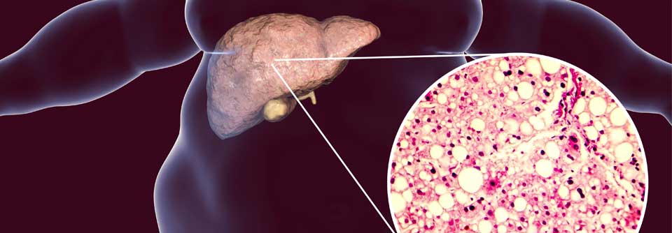 Das Krankheitsbild der nicht-alkoholischen Fettleber erweist sich als äußerst heterogen, entsprechend muss auch die Therapie individuell angepasst werden.