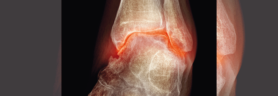 Der für Arthrose typische Knorpelschwund kann zu Funktionseinbußen führen.