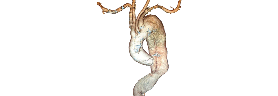 Diese 3D-Rekonstruktion aus der CT-Angiografie zeigt eine ausgedehnte Dissektion der thorakalen Aorta.