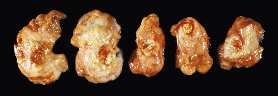 Bei chronisch kalzifizierender Pankreatitis lagern sich Kalziumsalze im Gewebe ab.