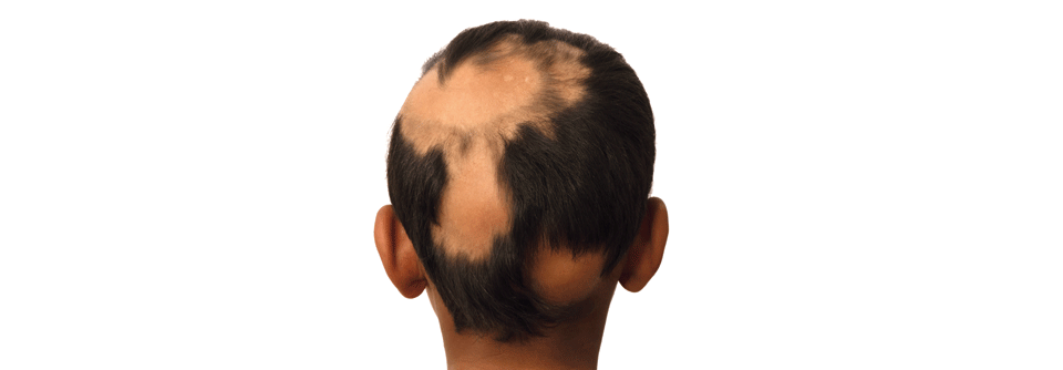 Es ist wohl ein autoimmunes Geschehen, das beim kreisrunden Haarausfall für die kahlen Stellen sorgt.