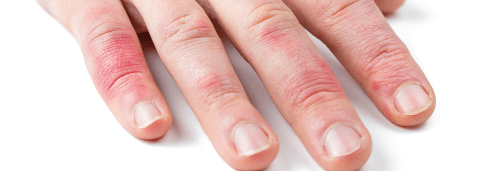 Im Gesicht zeigten sich Teleangiektasien, an den Fingergelenken rötlich-livide Verfärbungen und an den Händen insgesamt eine dünne, wachsartige Haut. (Agenturfoto)