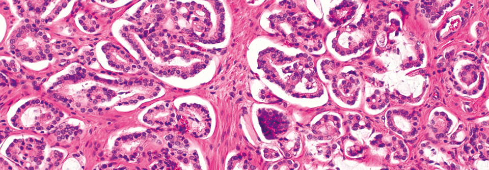 Histologisch zeigen sich bei Gleason-Grad 4 kleine, unregelmäßige Drüsen und schlecht differenzierte Bereiche.