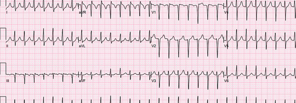 Das EKG einer 51-jährigen Patientin offenbart eine AV-Knoten-Reentry-Tachykardie.
