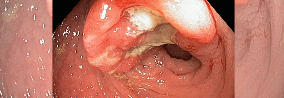 Adenokarzinome leiten sich vom Drüsengewebe ab. Hier eine maligne Neoplasie des Kolons.