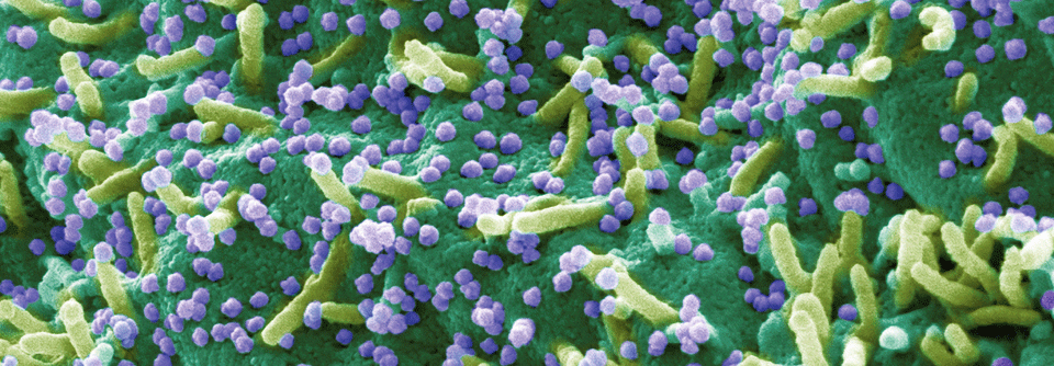 Bis zu 40 % der CED-Patienten entwickeln bei Infektion mit SARS-CoV-2 neue gastrointestinale Symptome.