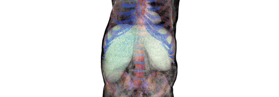 Ein markantes Krankheitszeichen der lysosomalen Speicherkrankheiten ist die Hepatosplenomegalie.