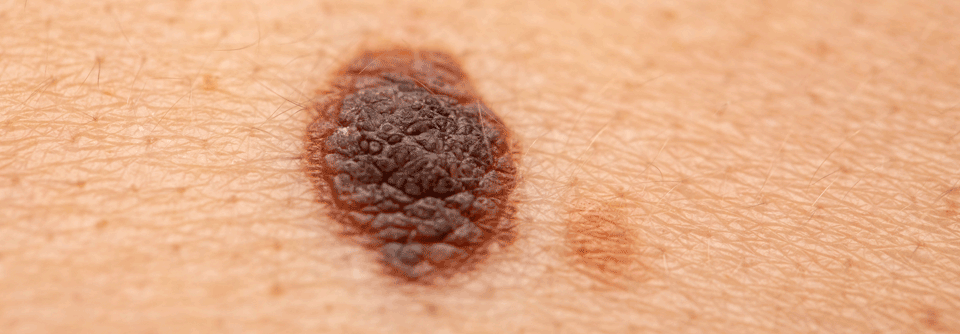 Studien untersuchen, ob die Infusion von autologen tumorinfiltrierenden Lymphozyten die Situation von Melanomerkrankten verbessert werden könnte.